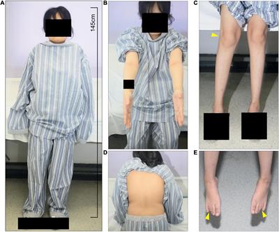 Case Report: Diagnosis of Mucopolysaccharidosis Type IVA With Compound Heterozygous Galactosamine-6 Sulfatase Variants and Biopsy of Replaced Femoral Heads